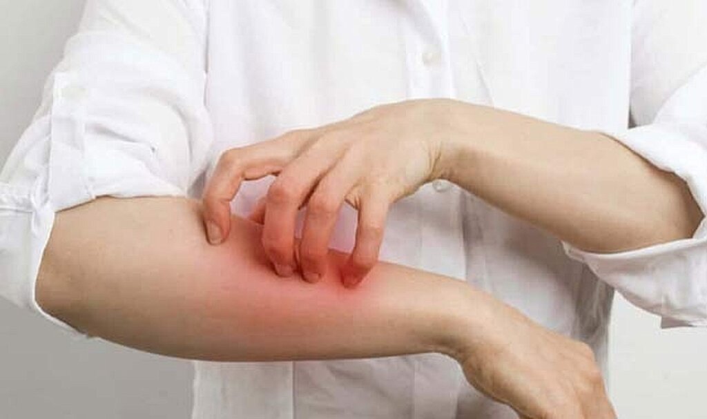 Uyuz Hastalığı neden olur? Uyuz hastalığı belirtileri  ve tedavisi