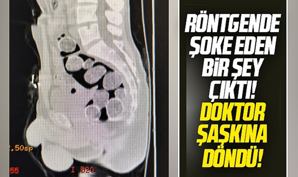 Samsun'da röntgeni çekilen iki kişinin midesine sakladıkları şoke etti!